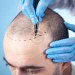 Post-procedure care tips for transplantation clients